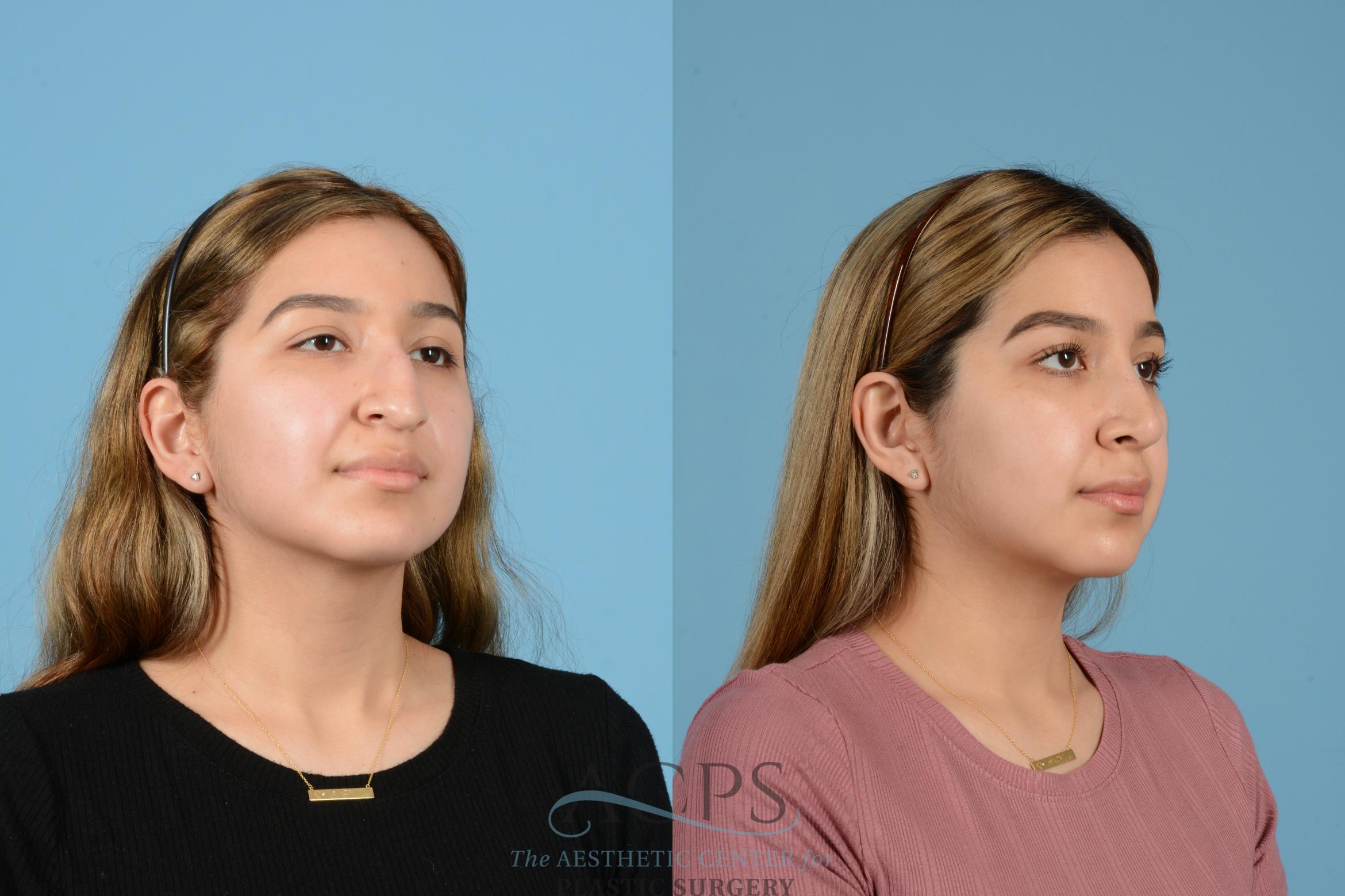 Before & After Rhinoplasty Case 1516 Right Oblique View in Houston, TX