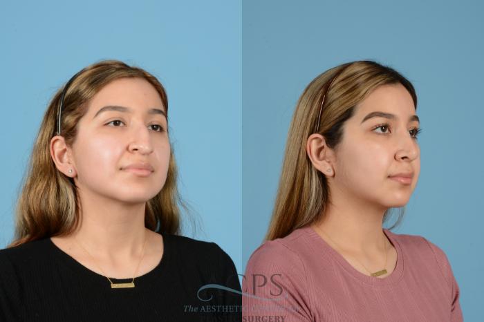 Before & After Rhinoplasty Case 1516 Right Oblique View in Houston, TX