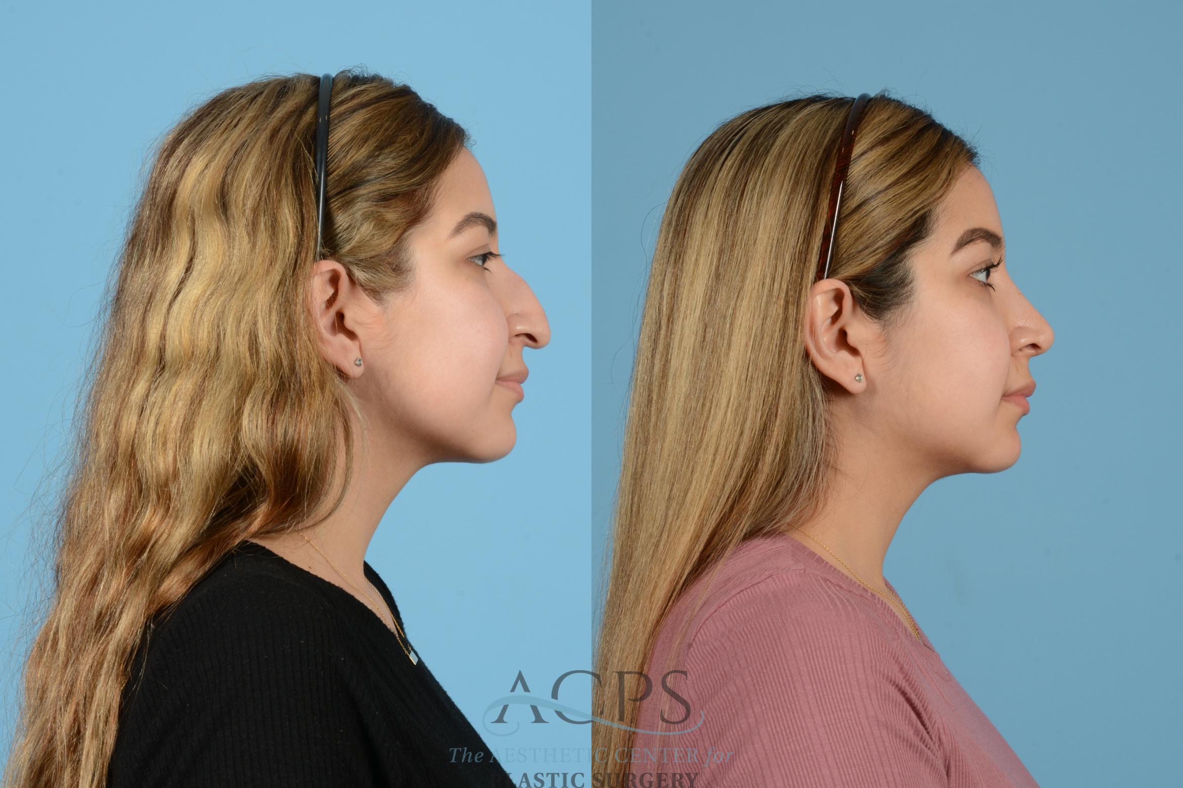 Before & After Rhinoplasty Case 1516 Right Side View in Houston, TX