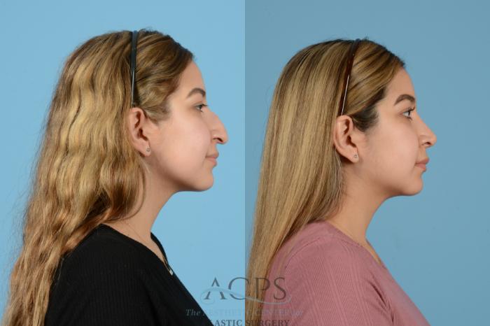 Before & After Rhinoplasty Case 1516 Right Side View in Houston, TX