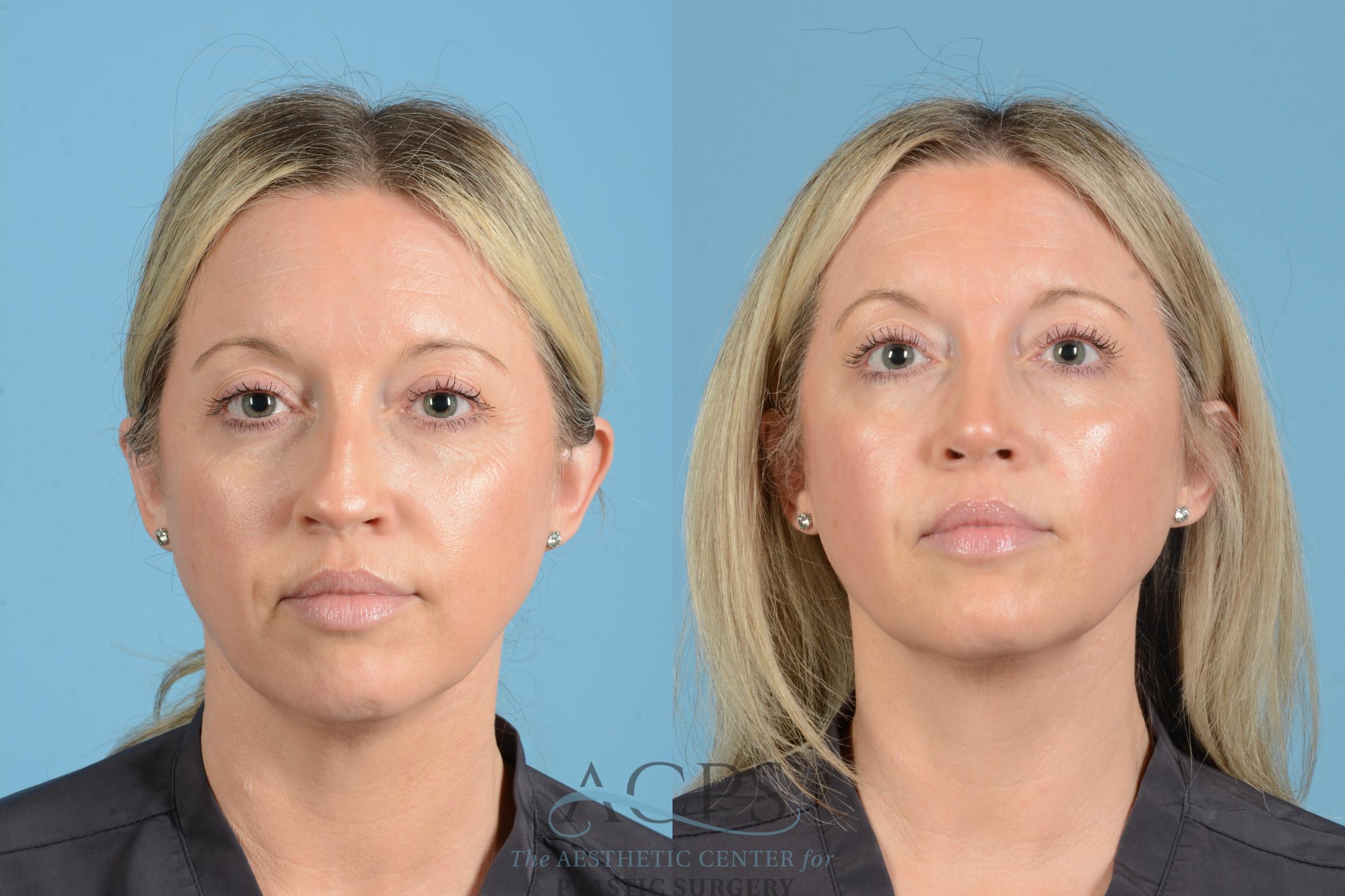 Before & After Rhinoplasty Case 1558 Front View in Houston, TX