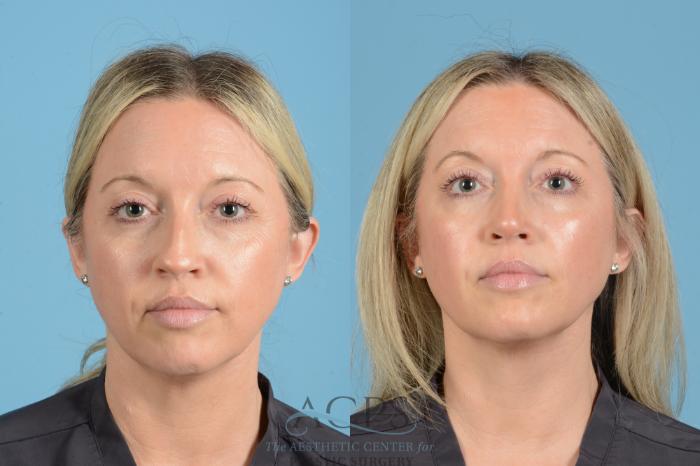 Before & After Rhinoplasty Case 1558 Front View in Houston, TX
