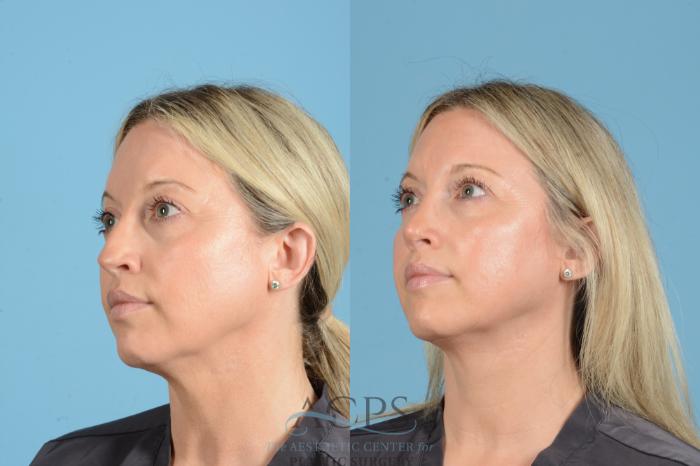 Before & After Rhinoplasty Case 1558 Left Oblique View in Houston, TX