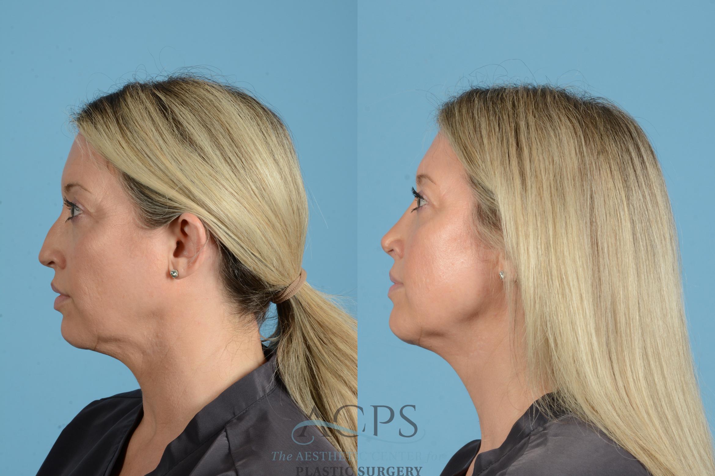 Before & After Rhinoplasty Case 1558 Left Side View in Houston, TX