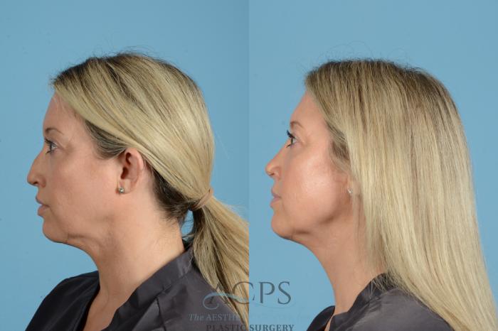 Before & After Rhinoplasty Case 1558 Left Side View in Houston, TX