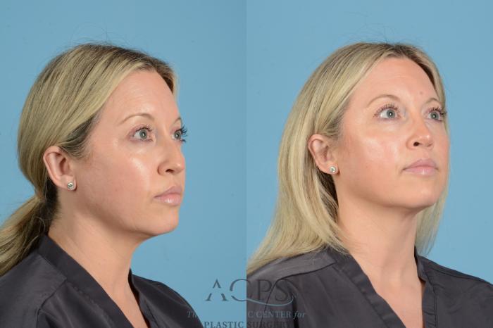 Before & After Rhinoplasty Case 1558 Right Oblique View in Houston, TX