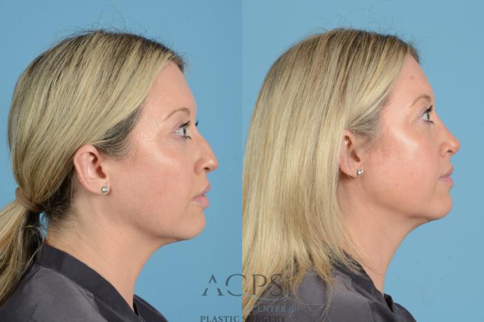 Before & After Rhinoplasty Case 1558 Right Side View in Houston, TX