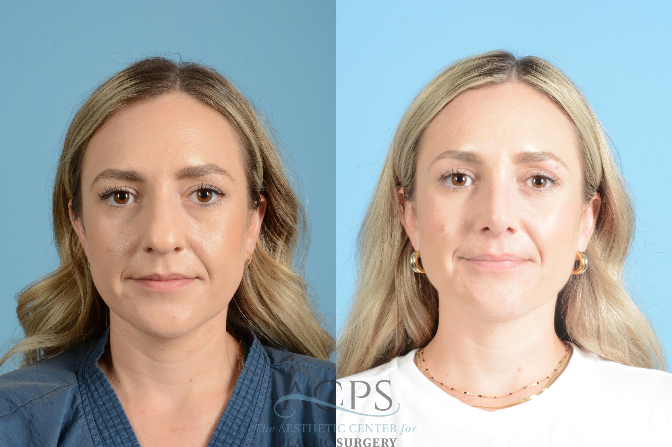 Before & After Rhinoplasty Case 1559 Front View in Houston, TX