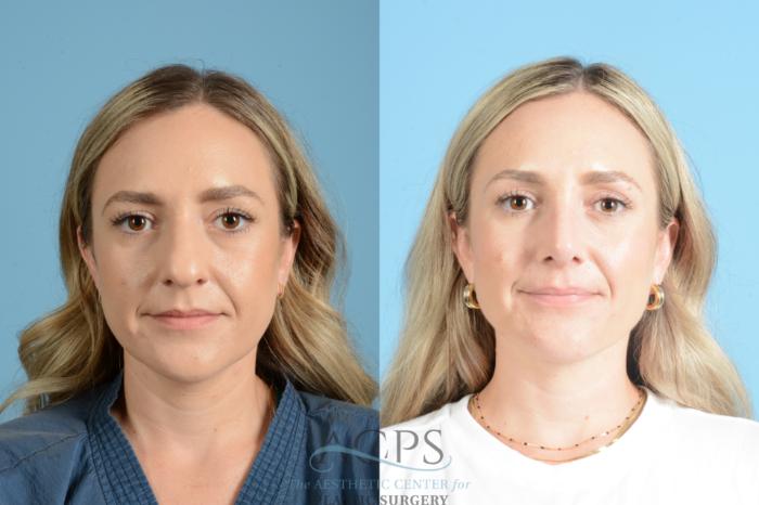 Before & After Rhinoplasty Case 1559 Front View in Houston, TX