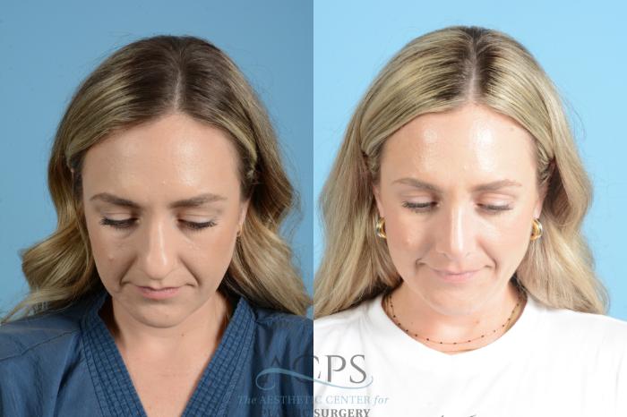 Before & After Rhinoplasty Case 1559 Front View – Chin Down View in Houston, TX