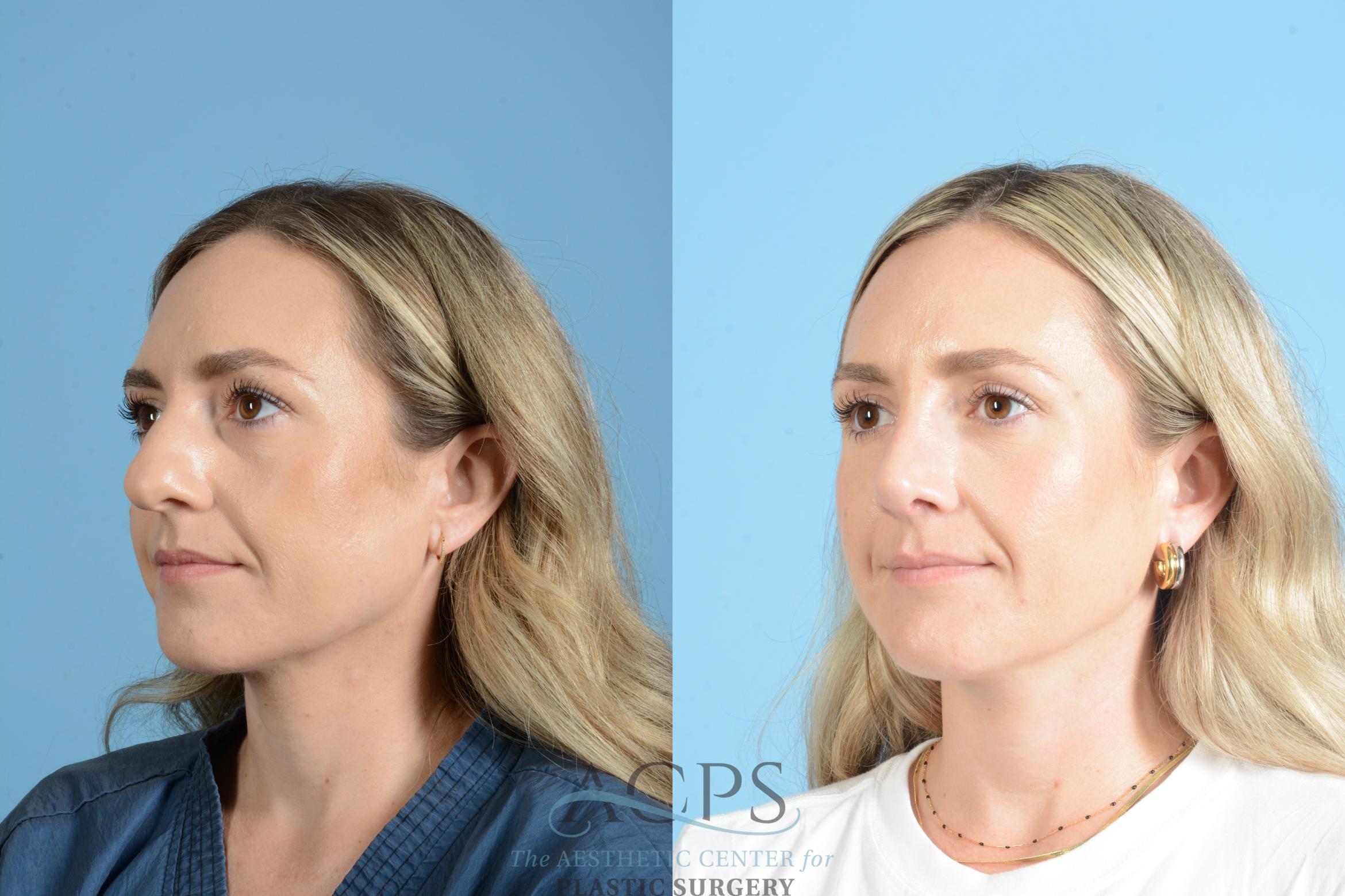 Before & After Rhinoplasty Case 1559 Left Oblique View in Houston, TX