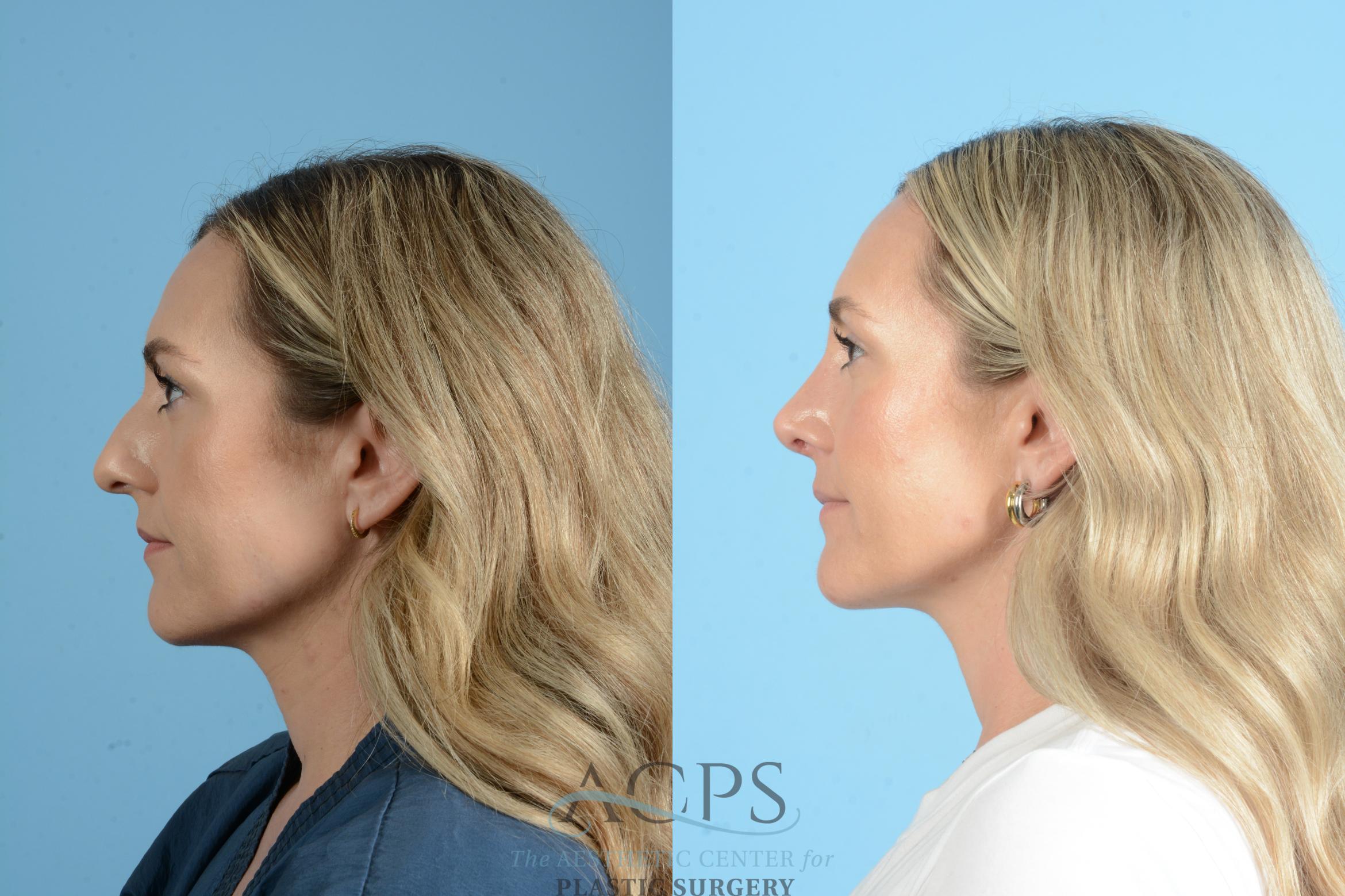Before & After Rhinoplasty Case 1559 Left Side View in Houston, TX