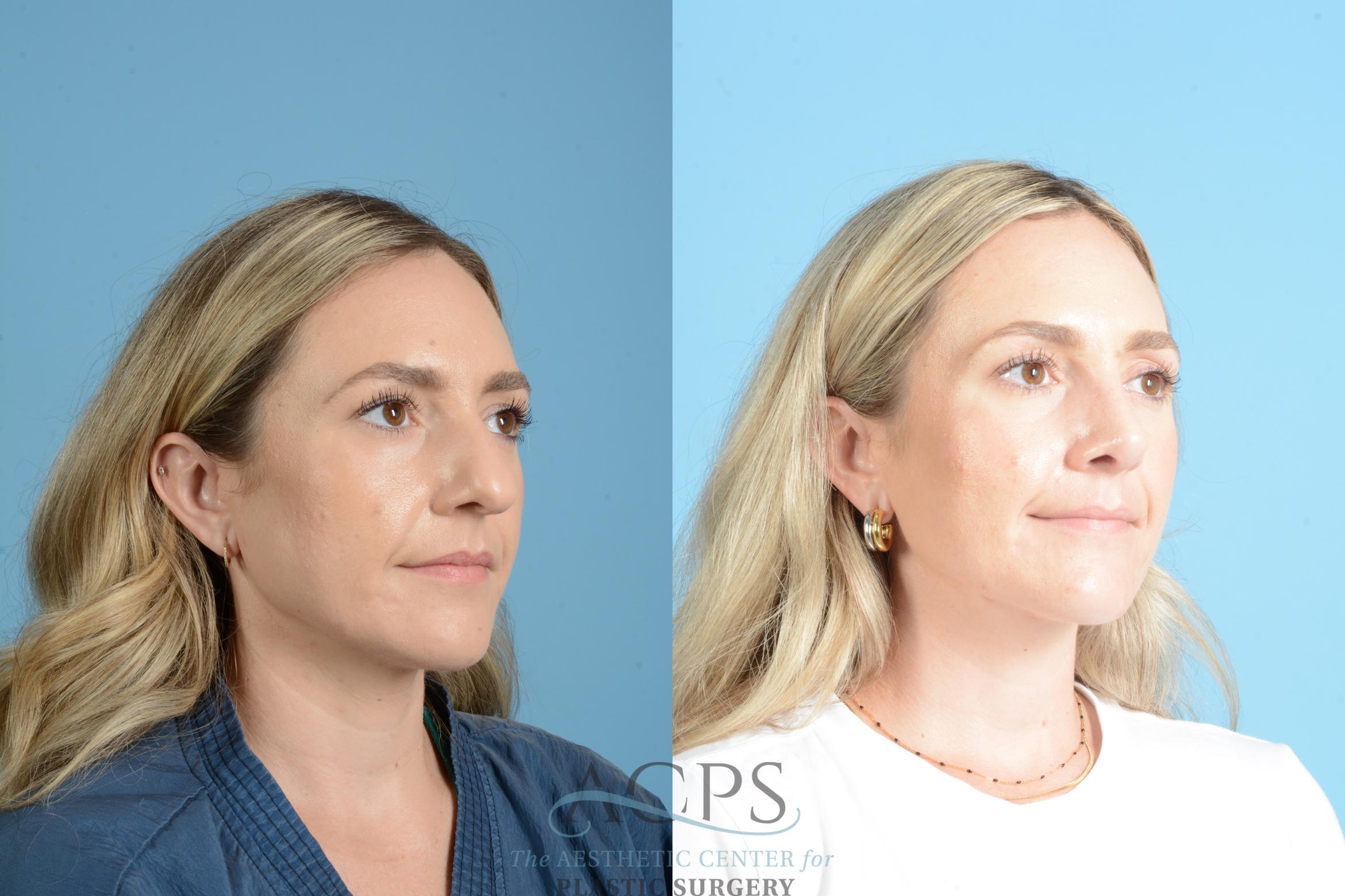 Before & After Rhinoplasty Case 1559 Right Oblique View in Houston, TX