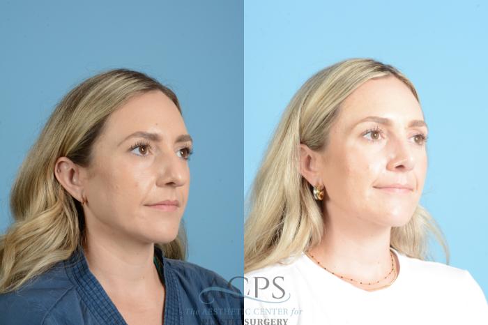 Before & After Rhinoplasty Case 1559 Right Oblique View in Houston, TX