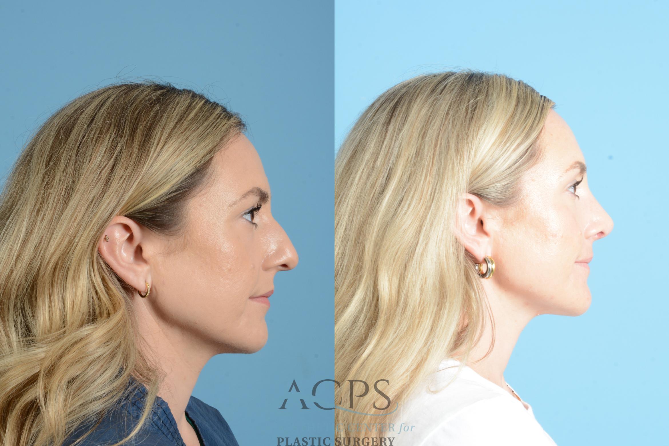 Before & After Rhinoplasty Case 1559 Right Side View in Houston, TX