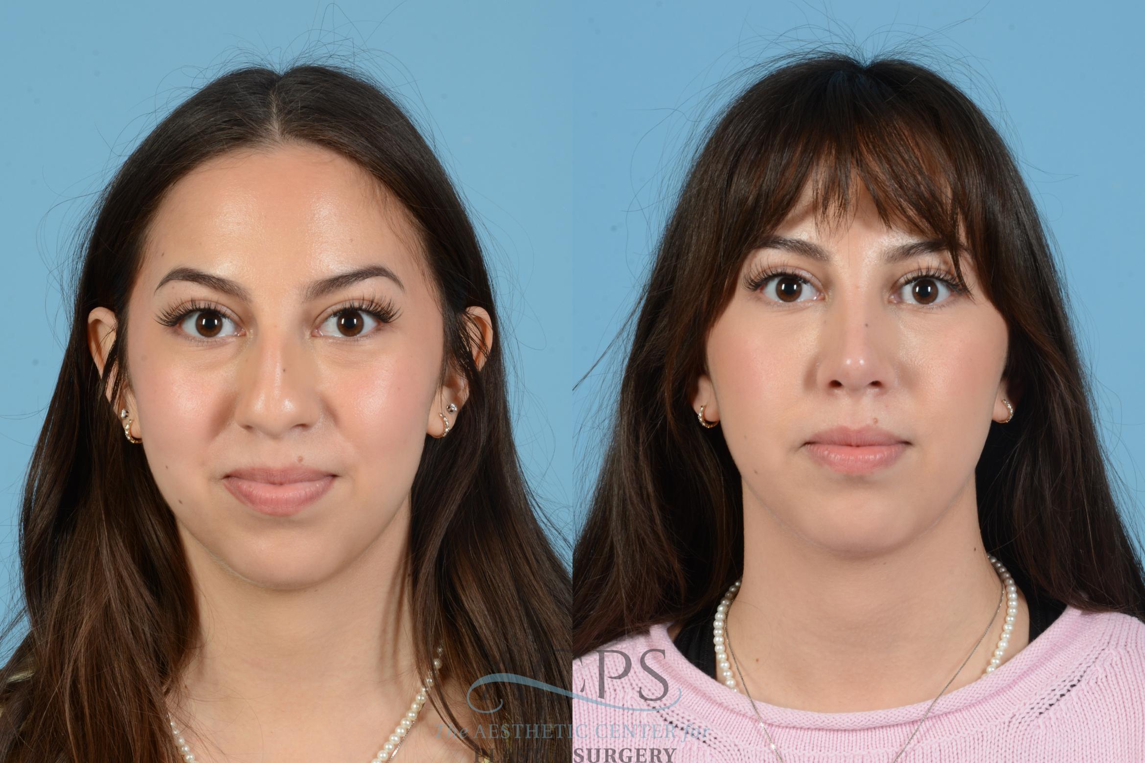 Before & After Septoplasty with Rhinoplasty Case 1560 Front View in Houston, TX