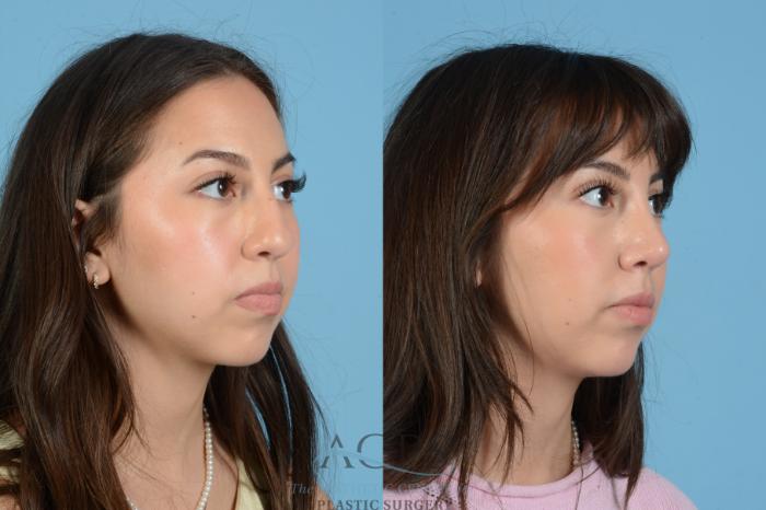Before & After Septoplasty with Rhinoplasty Case 1560 Left Oblique View in Houston, TX