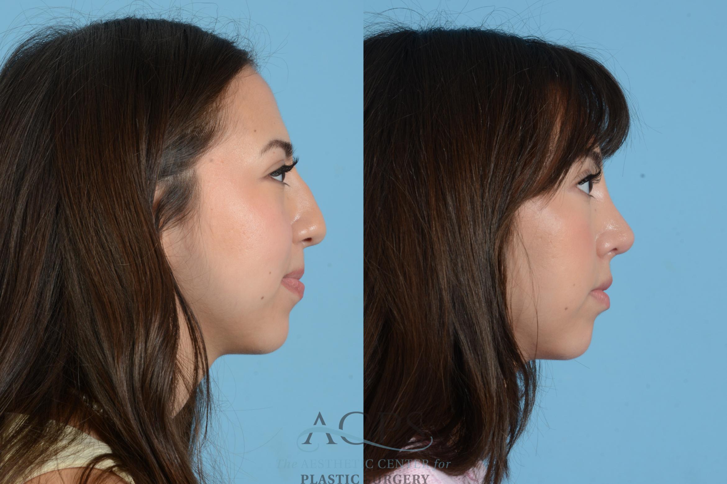 Before & After Septoplasty with Rhinoplasty Case 1560 Left Side View in Houston, TX