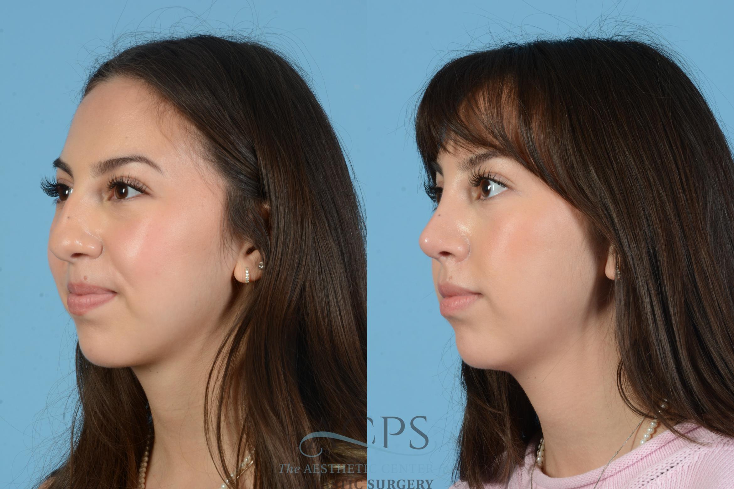 Before & After Septoplasty with Rhinoplasty Case 1560 Right Oblique View in Houston, TX