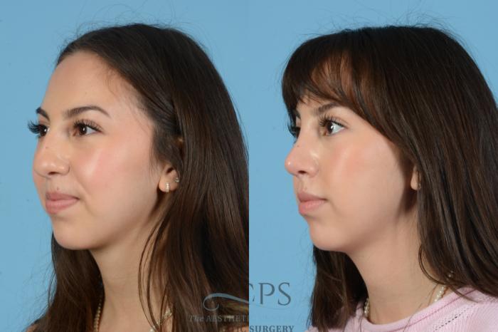 Before & After Septoplasty with Rhinoplasty Case 1560 Right Oblique View in Houston, TX