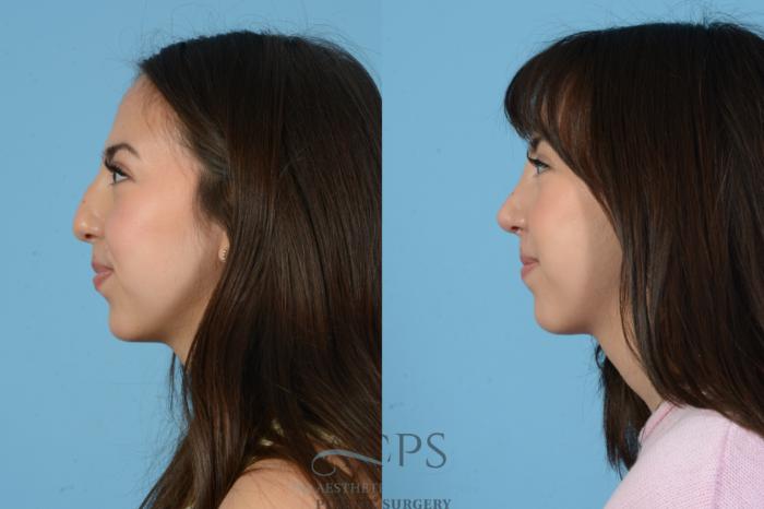 Before & After Septoplasty with Rhinoplasty Case 1560 Right Side View in Houston, TX