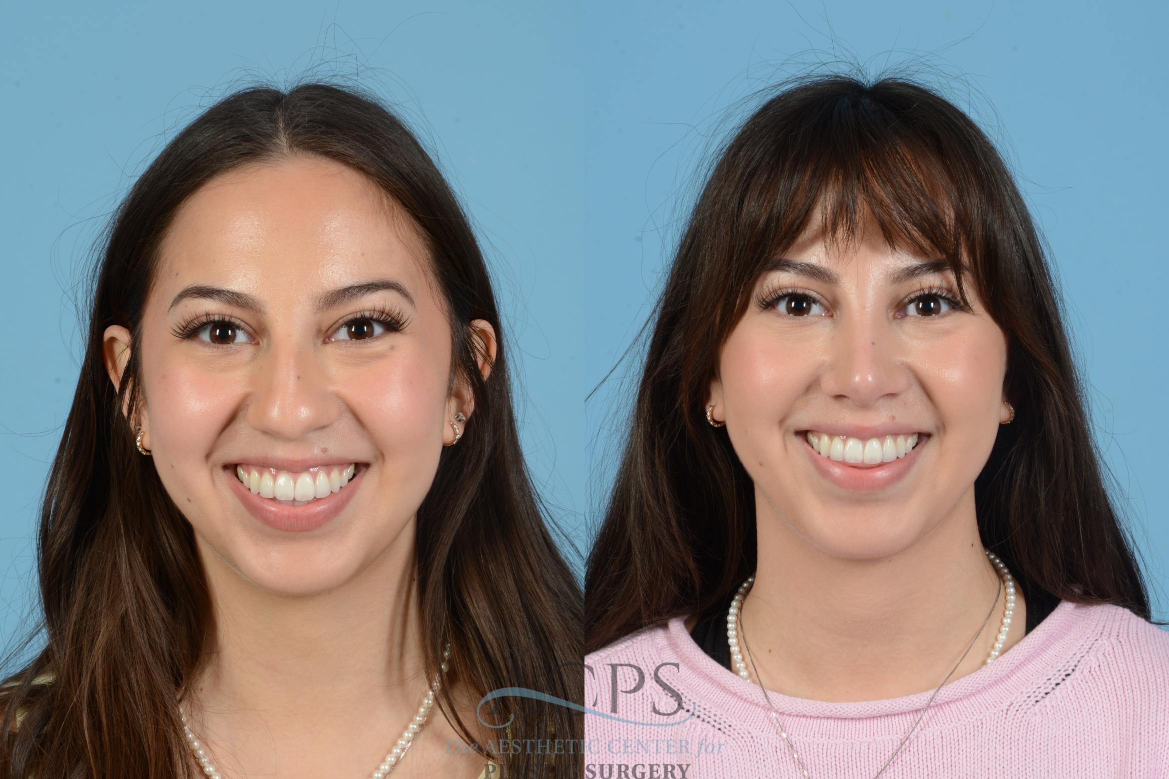 Before & After Septoplasty with Rhinoplasty Case 1560 Smile Front View in Houston, TX