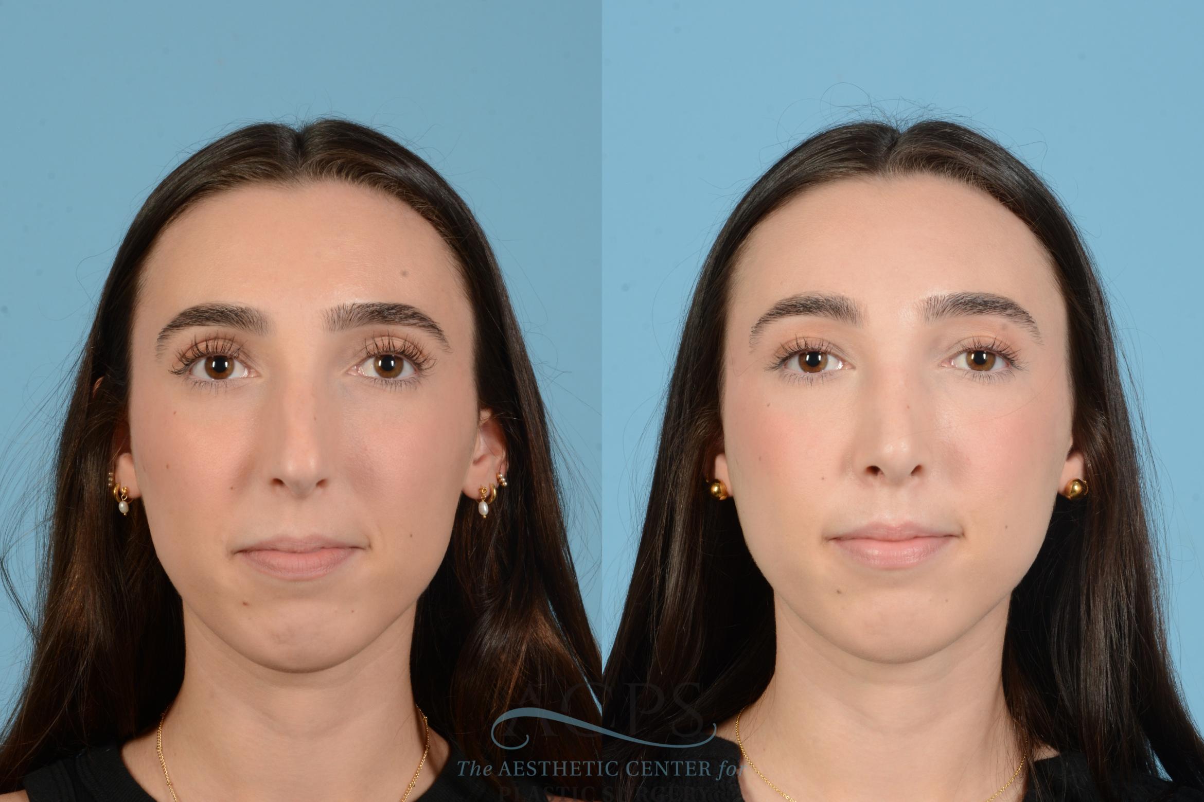 Before & After Rhinoplasty Case 1562 Front View in Houston, TX