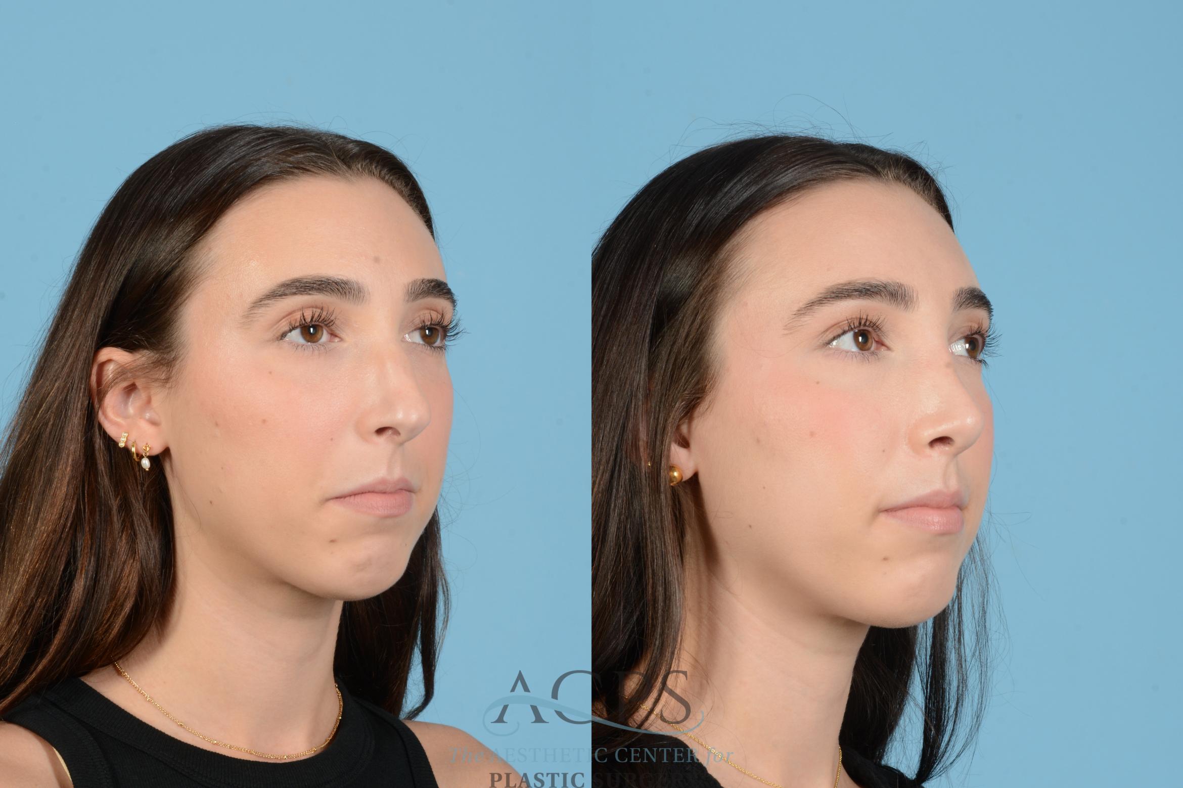 Before & After Rhinoplasty Case 1562 Left Oblique View in Houston, TX
