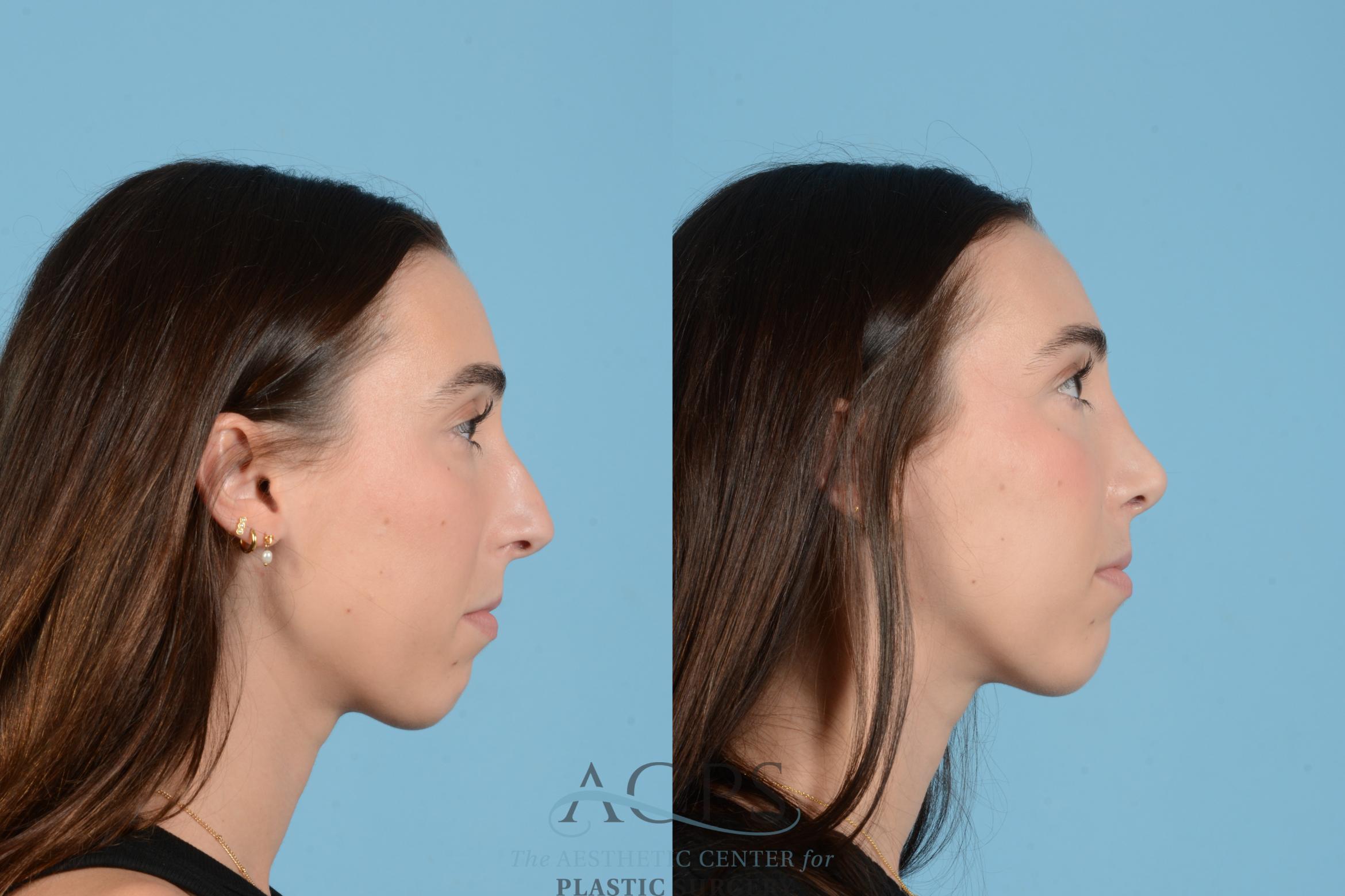 Before & After Rhinoplasty Case 1562 Left Side View in Houston, TX