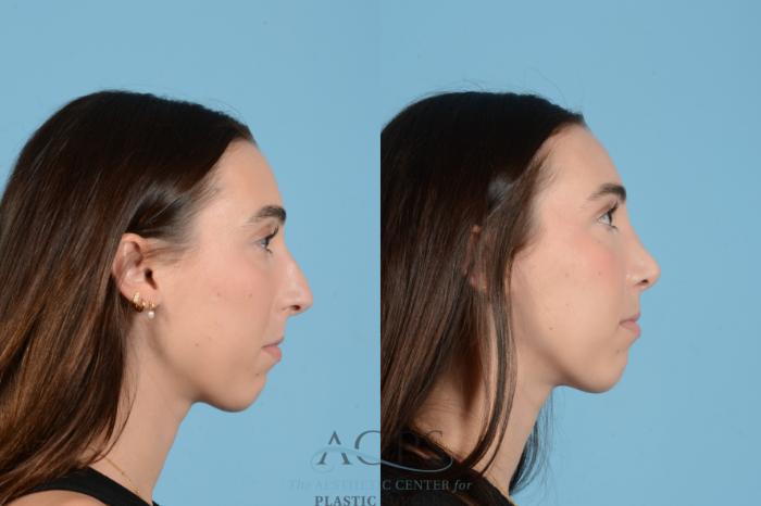 Before & After Rhinoplasty Case 1562 Left Side View in Houston, TX