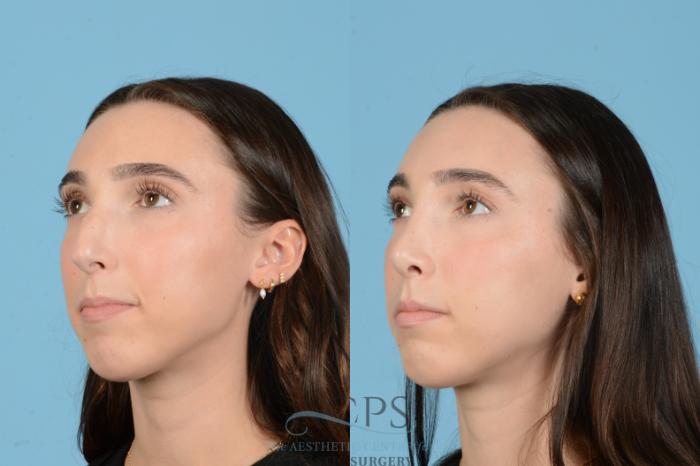 Before & After Rhinoplasty Case 1562 Right Oblique View in Houston, TX