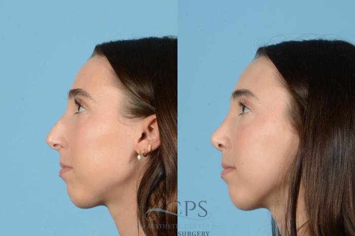 Before & After Rhinoplasty Case 1562 Right Side View in Houston, TX