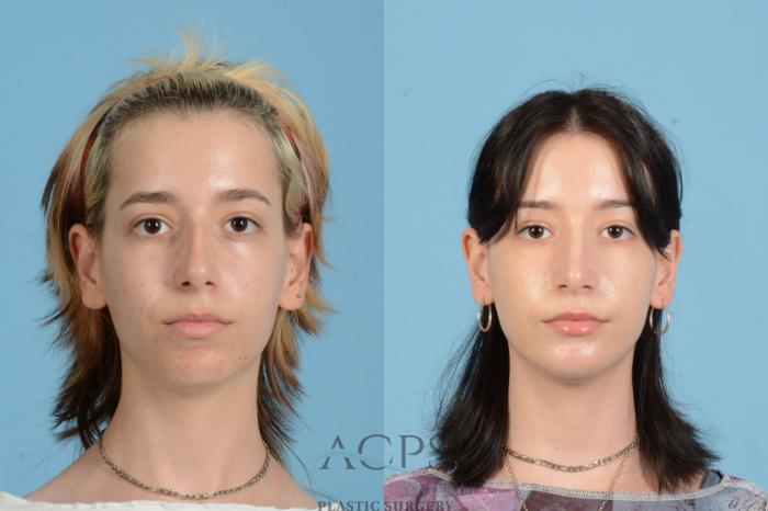 Before & After Rhinoplasty Case 1564 Front View in Houston, TX
