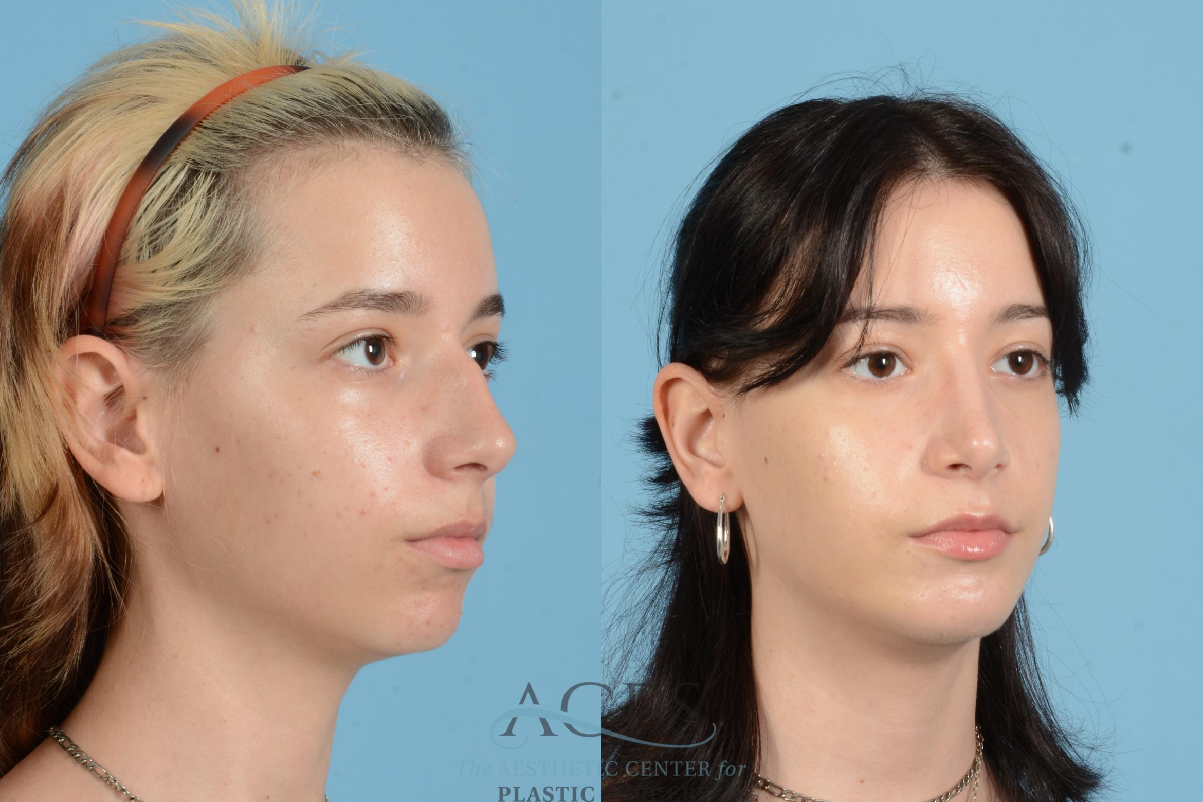 Before & After Rhinoplasty Case 1564 Left Oblique View in Houston, TX