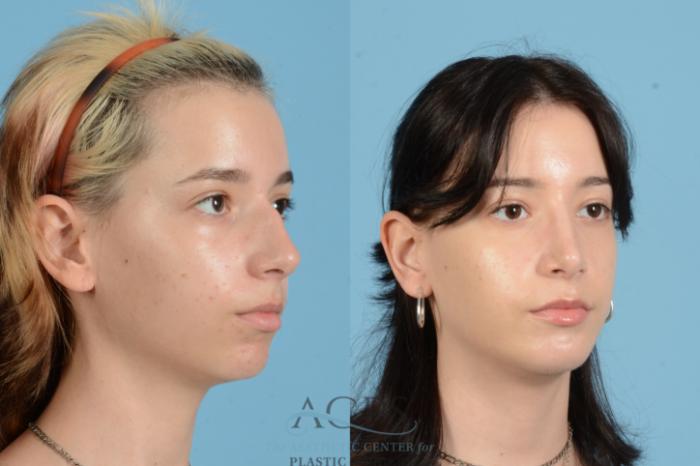 Before & After Rhinoplasty Case 1564 Left Oblique View in Houston, TX