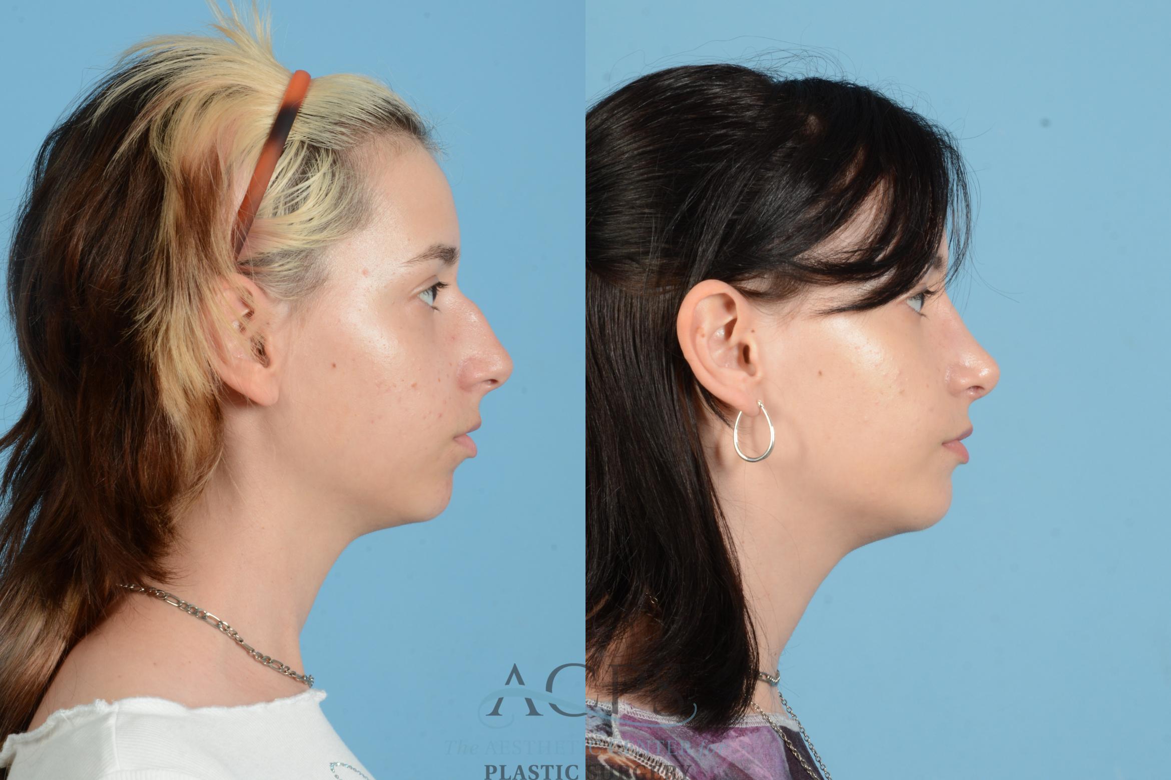 Before & After Rhinoplasty Case 1564 Left Side View in Houston, TX