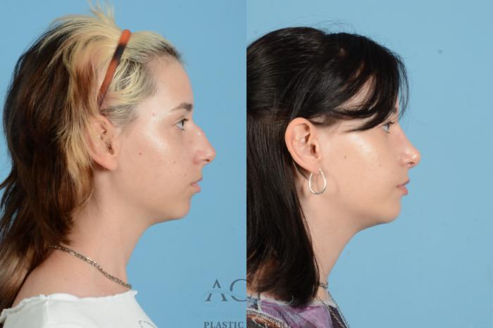 Before & After Rhinoplasty Case 1564 Left Side View in Houston, TX