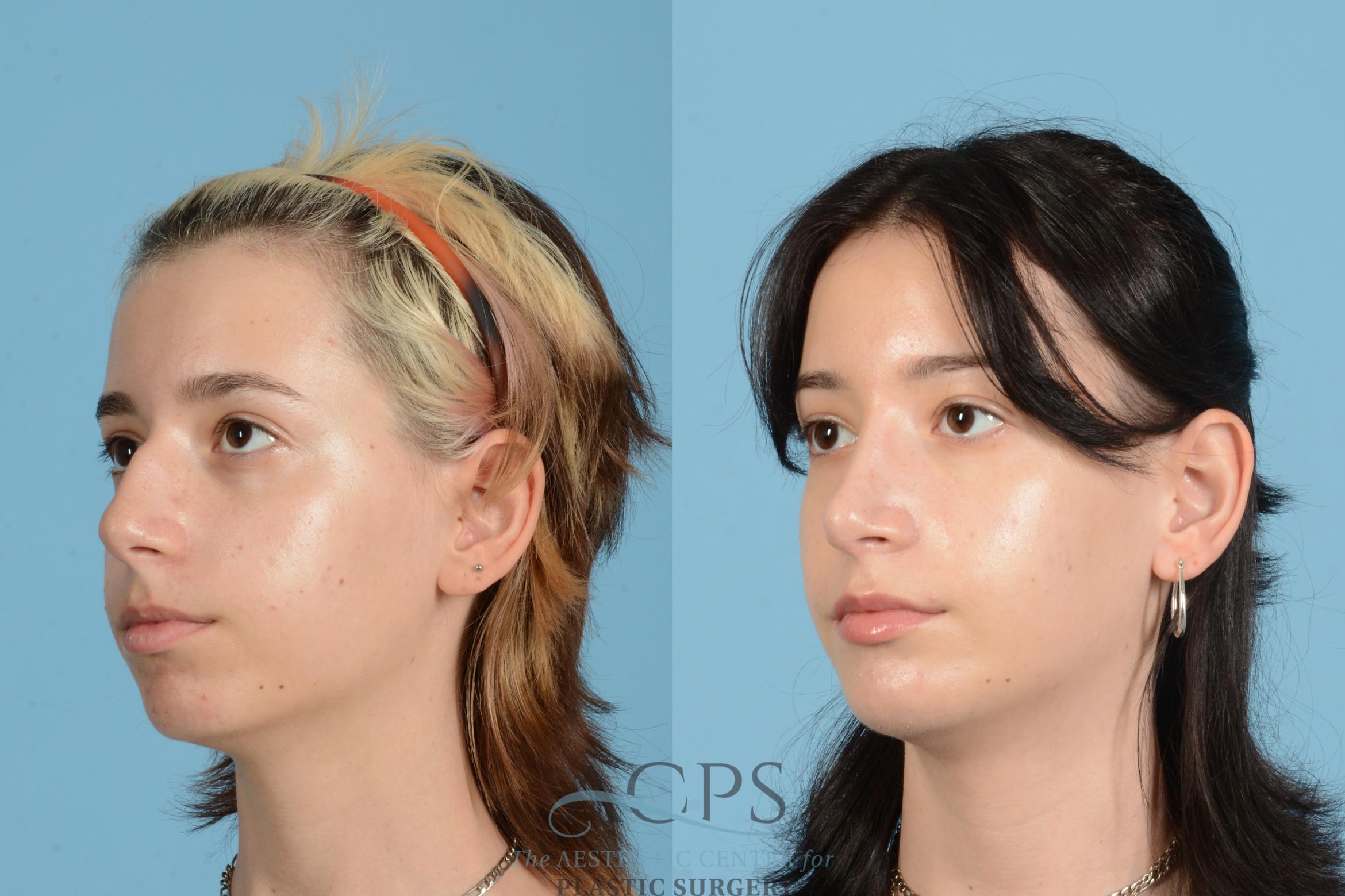 Before & After Rhinoplasty Case 1564 Right Oblique View in Houston, TX