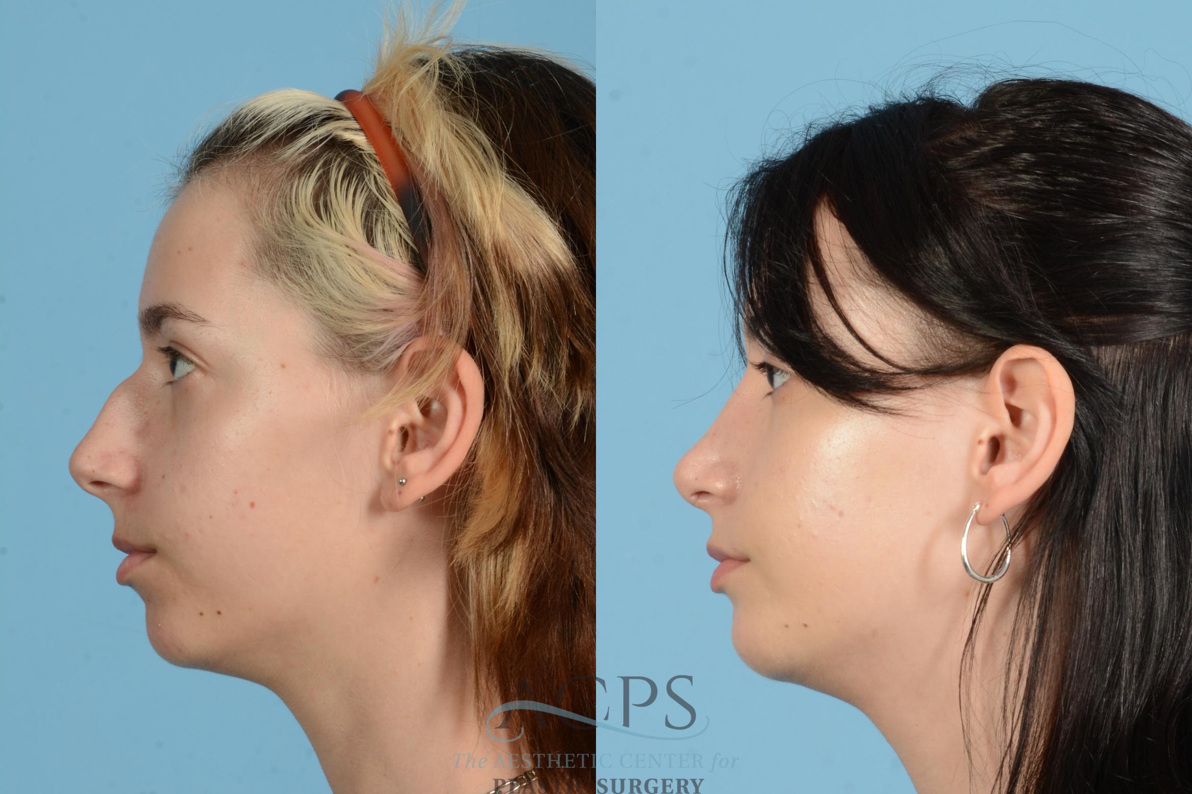 Before & After Rhinoplasty Case 1564 Right Side View in Houston, TX