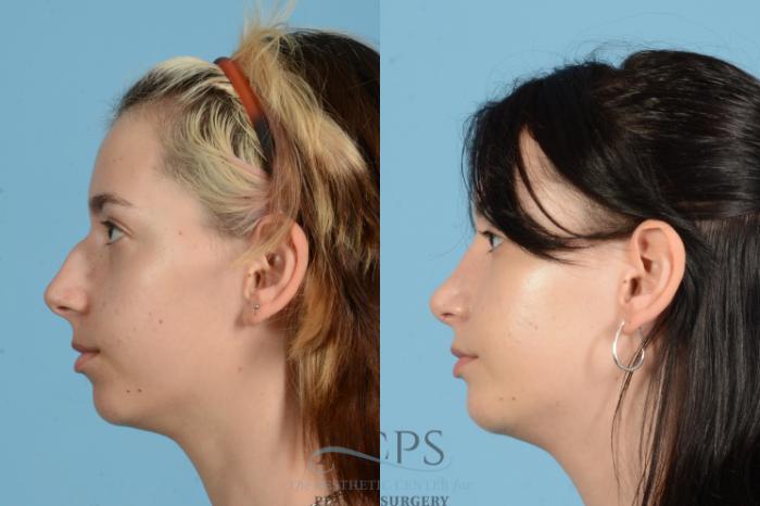 Before & After Rhinoplasty Case 1564 Right Side View in Houston, TX