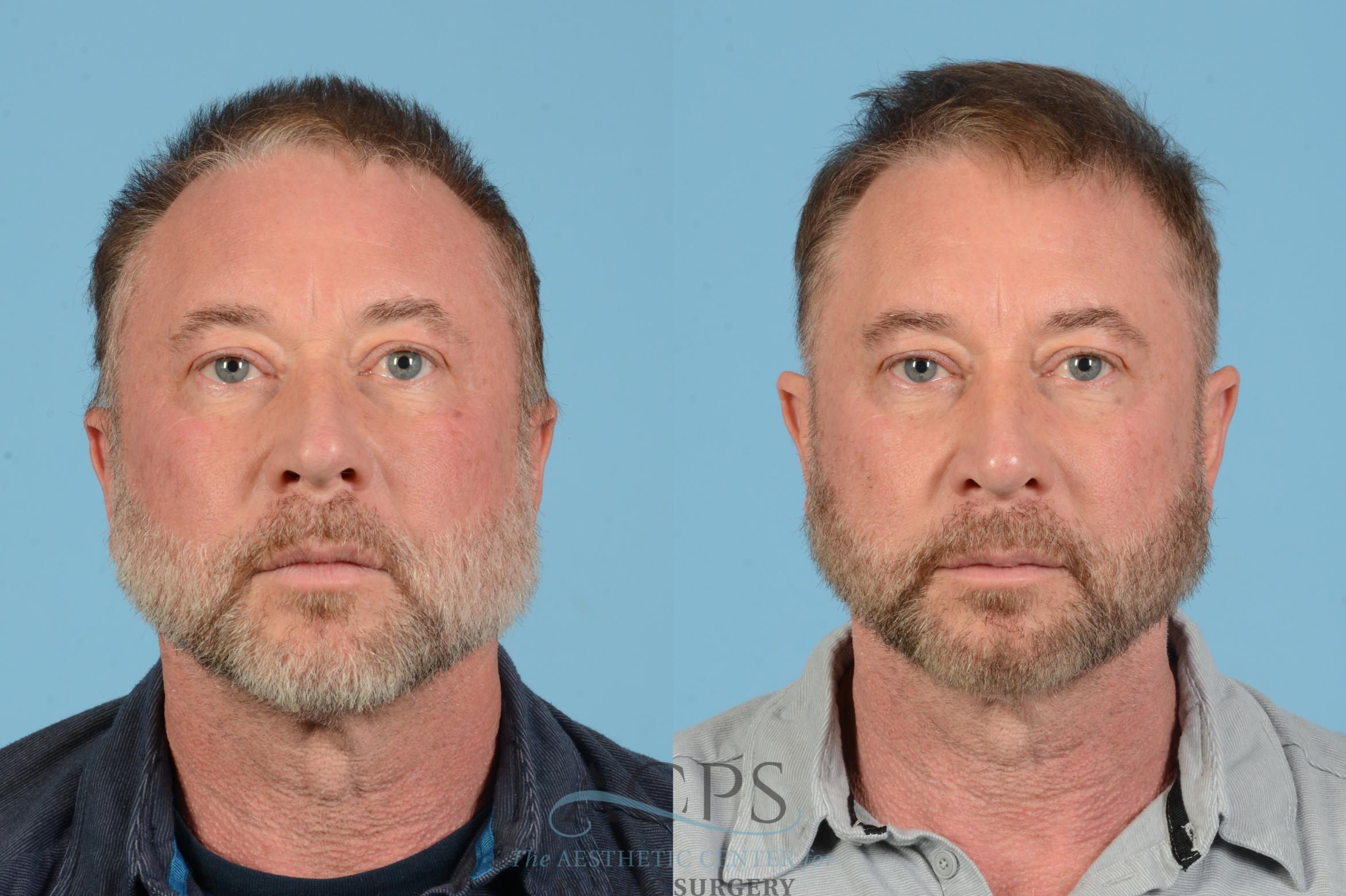 Before & After Rhinoplasty Case 1565 Front View in Houston, TX