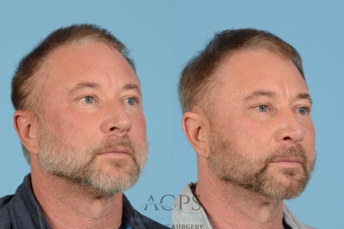 Before & After Rhinoplasty Case 1565 Left Oblique View in Houston, TX
