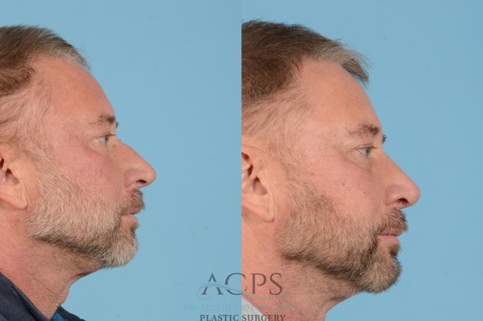 Before & After Rhinoplasty Case 1565 Left Side View in Houston, TX