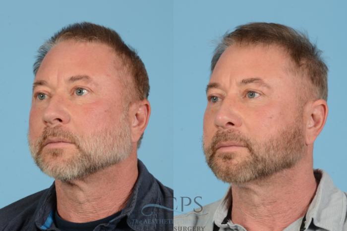 Before & After Rhinoplasty Case 1565 Right Oblique View in Houston, TX