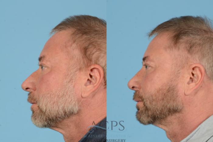 Before & After Rhinoplasty Case 1565 Right Side View in Houston, TX