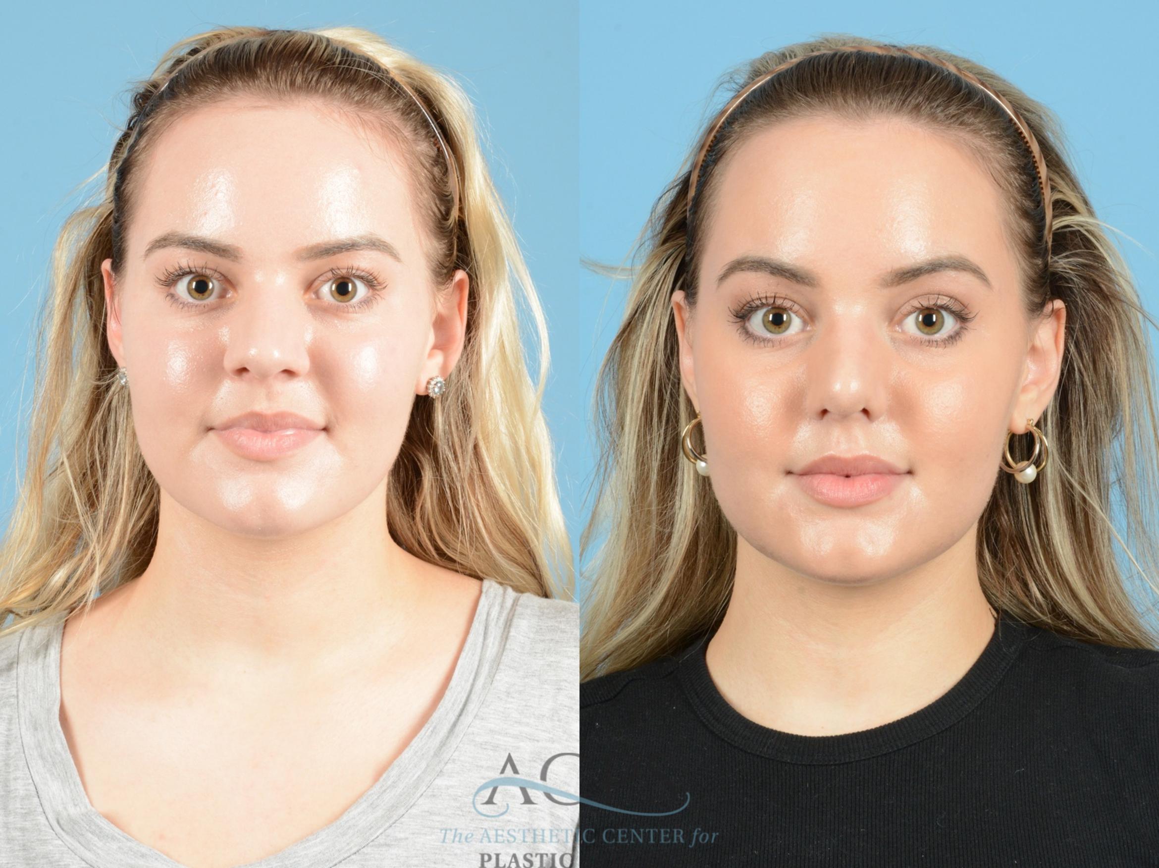 Before & After Septoplasty with Rhinoplasty Case 1369 Front View: View in Houston, TX