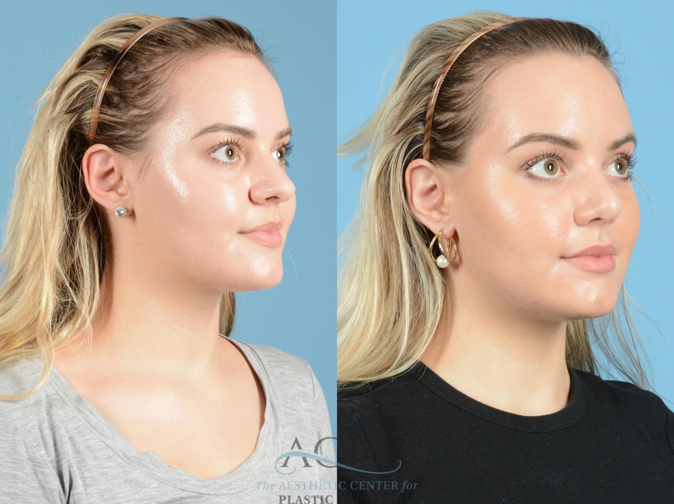 Before & After Septoplasty with Rhinoplasty Case 1369 Oblique View: View in Houston, TX