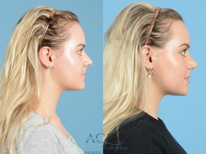 Before & After Septoplasty with Rhinoplasty Case 1369 Side View: View in Houston, TX