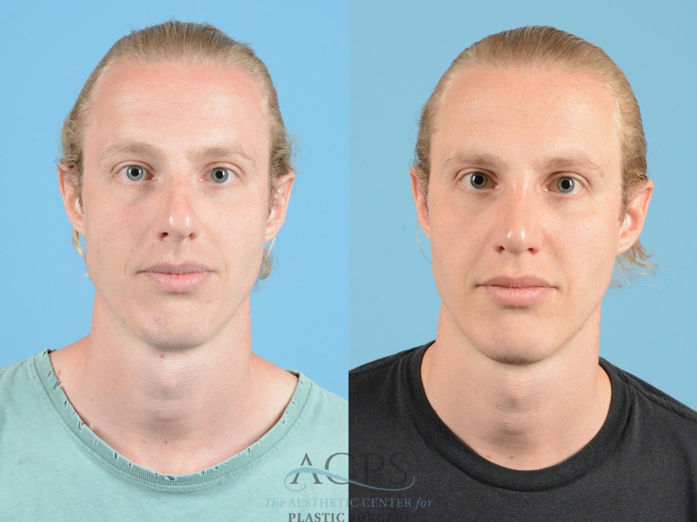 Before & After Septoplasty with Rhinoplasty Case 1371 Front View: View in Houston, TX