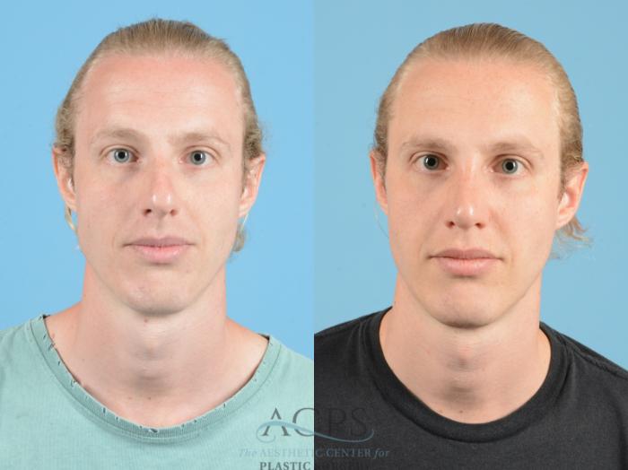 Before & After Septoplasty with Rhinoplasty Case 1371 Front View: View in Houston, TX